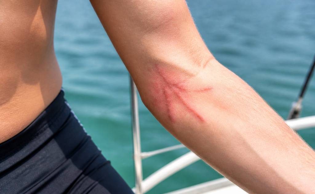Brulure de meduse : que faire et comment la soulager en mer