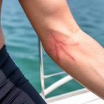 Brulure de meduse : que faire et comment la soulager en mer