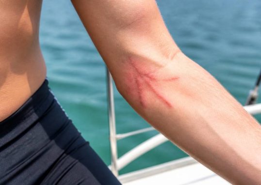 Brulure de meduse : que faire et comment la soulager en mer
