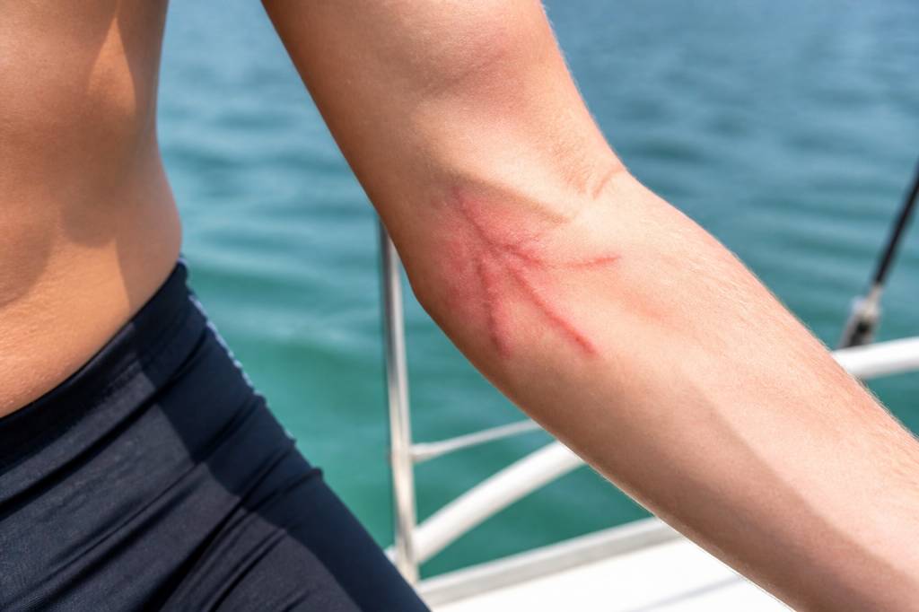 Brulure de meduse : que faire et comment la soulager en mer