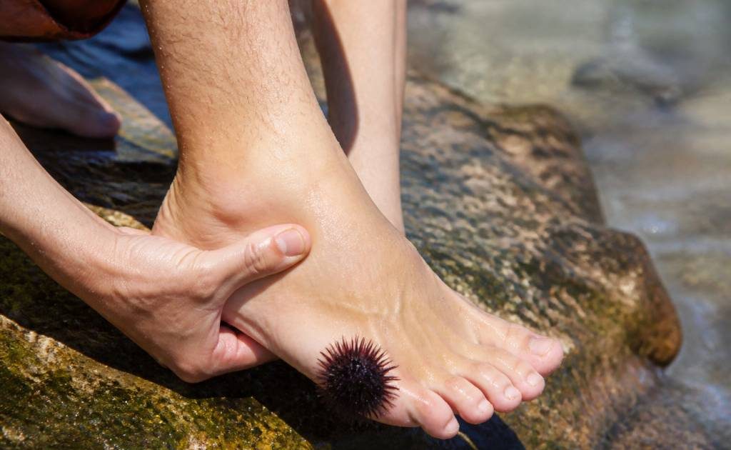 Marcher sur un oursin : que faire et comment soulager la douleur