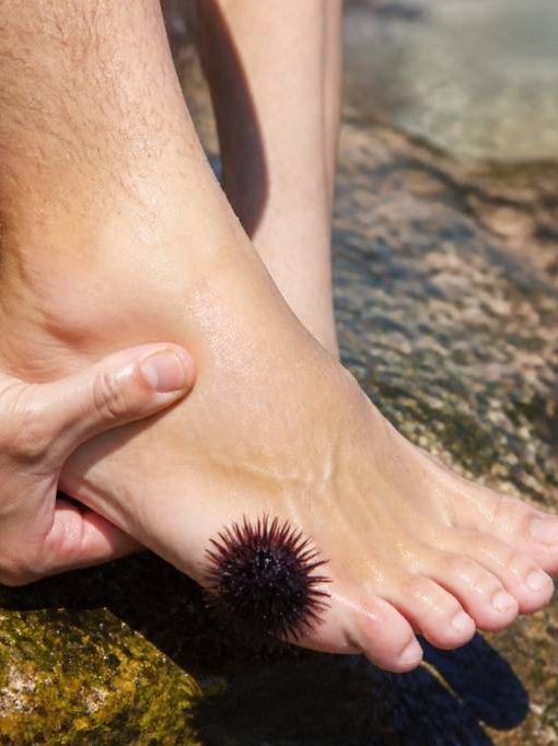 Marcher sur un oursin : que faire et comment soulager la douleur