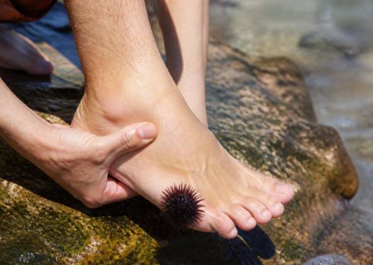 Marcher sur un oursin : que faire et comment soulager la douleur