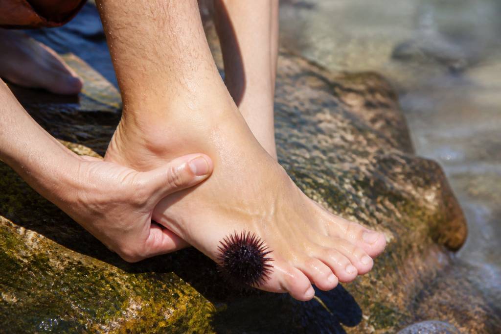 Marcher sur un oursin : que faire et comment soulager la douleur